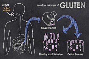Serious Consequences of Celiac Disease