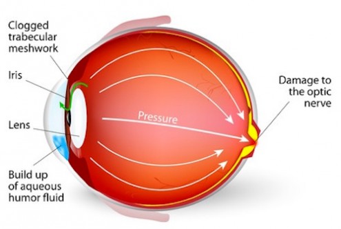 How to Effectively Control Your Glaucoma
