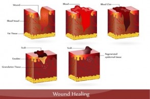 Ask Dr. Mike: How Can I Speed Up Wound Healing?