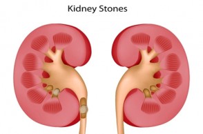 Painful Truth About Kidney Stones 