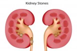 the-painful-truth-about-kidney-stones