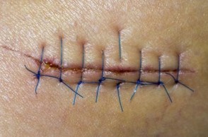 First Aid Kit or ER? Determining if a Cut Needs Stitches