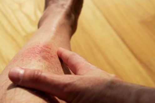 What Causes Eczema?
