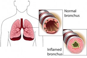 Link Between Eczema & Asthma