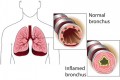 Link Between Eczema & Asthma