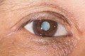 Cataracts: Symptoms & Solutions