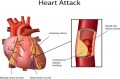 Busting the Cholesterol Myth: 4 Major Risk Factors for Heart Disease