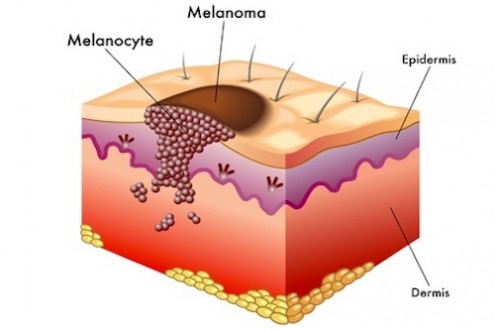 Melanoma: How to Prevent &amp; Treat the Deadliest Skin Cancer