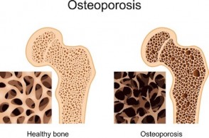 Heal Your Osteoporosis with the Help of Micronutrients