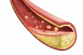 New Guidelines on Cholesterol: Part 2
