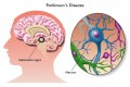 New Treatments for Parkinson's Disease