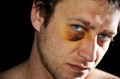 Severe Facial Lacerations & Other Injuries
