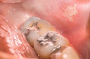 Are Mercury Fillings Really that Bad?