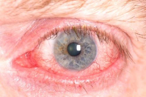 Eye Redness: Causes, Symptoms &amp; Complications