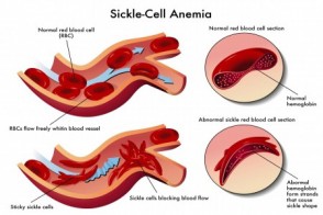 Can Cord Blood Cure Sickle Cell? 