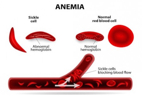 Sickle Cell Anemia: One Woman’s Journey