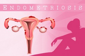 Endometriosis: The Shocking Disease Affecting 1 in 10 Women