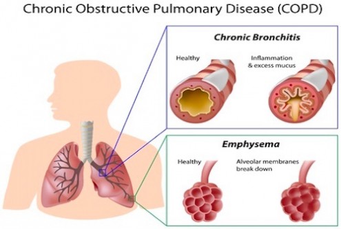 Stem Cell Therapies Help Treat COPD