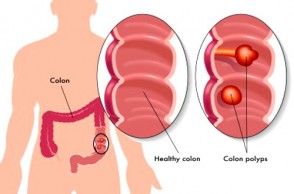 Colon Cancer Screening: It Could Save Your Life