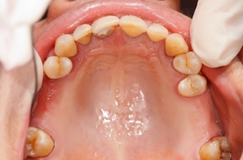Gum Disease: The Silent Killer