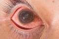 Introduction to Intraocular Inflammation