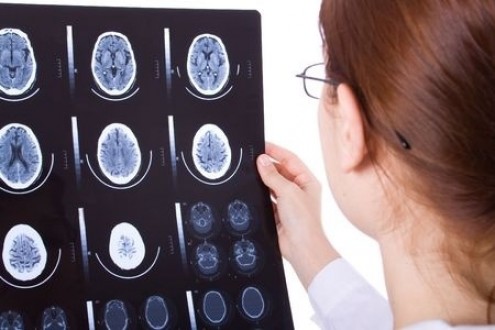 MRI Scan May Predict Alzheimer&#039;s Disease