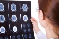 MRI Scan May Predict Alzheimer's Disease