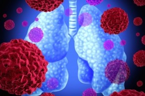 Advances in Lung Cancer Care: From Diagnosis to Treatment