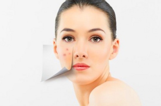 Clearing Up the Mystery of Adult Acne