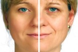 Facelift Facts: What to Know Before You Go Under the Knife