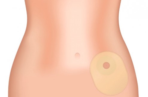 Crohn’s Disease: How Ostomy Surgery Can Save Your Life