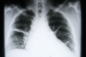 The Lung Cancer Vaccine from Cuba: Is Hope on the Horizon?
