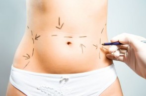 Abdominoplasty: What to Know Before Your Tummy Tuck