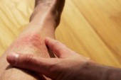 What Causes Eczema?