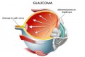 Dear Doctor: What Is Glaucoma?