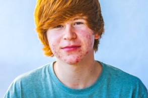 Does Your Child Suffer From Acne? 