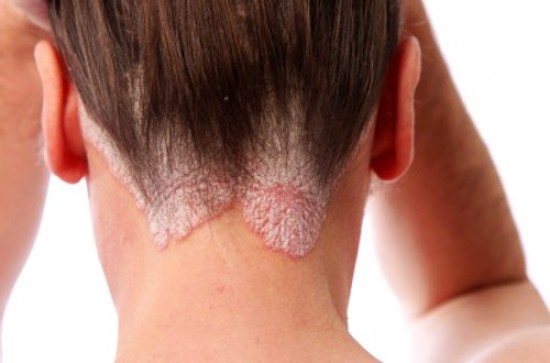 Psoriasis: The Burden of an Ugly Skin Condition 
