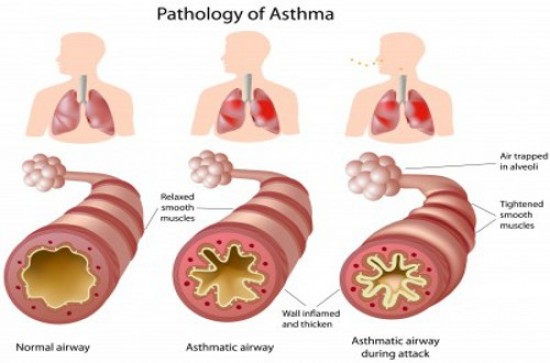 Get Smart About Asthma and Inflammation