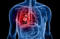 Navigating a Diagnosis of Lung Cancer