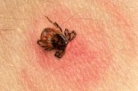 How to Prevent the Spread of Lyme Disease