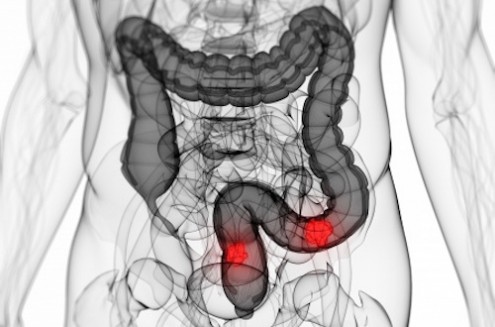 Preventing Colon Cancer with Vitamin D &amp; Metformin