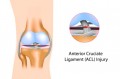 What is the Truth About Your ACL?