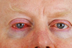 Itchy, Irritated Eyes? It Could Be Pinkeye