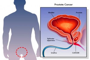 New Diagnostic Tests for Prostate Cancer