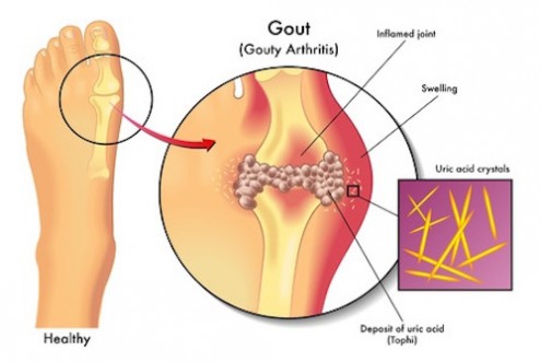 Ask Dr. Mike: What Foods Can &amp; Can&#039;t You Eat with Gout?