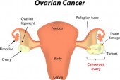 Ovarian Cancer: What You Need to Know