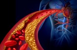 Cholesterol &amp; Heart Disease: What Is the Real Connection?