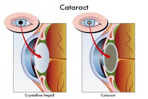 Dear Doctor: What Is a Cataract?