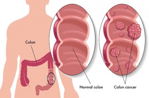 Healthy Aging: Colon Cancer